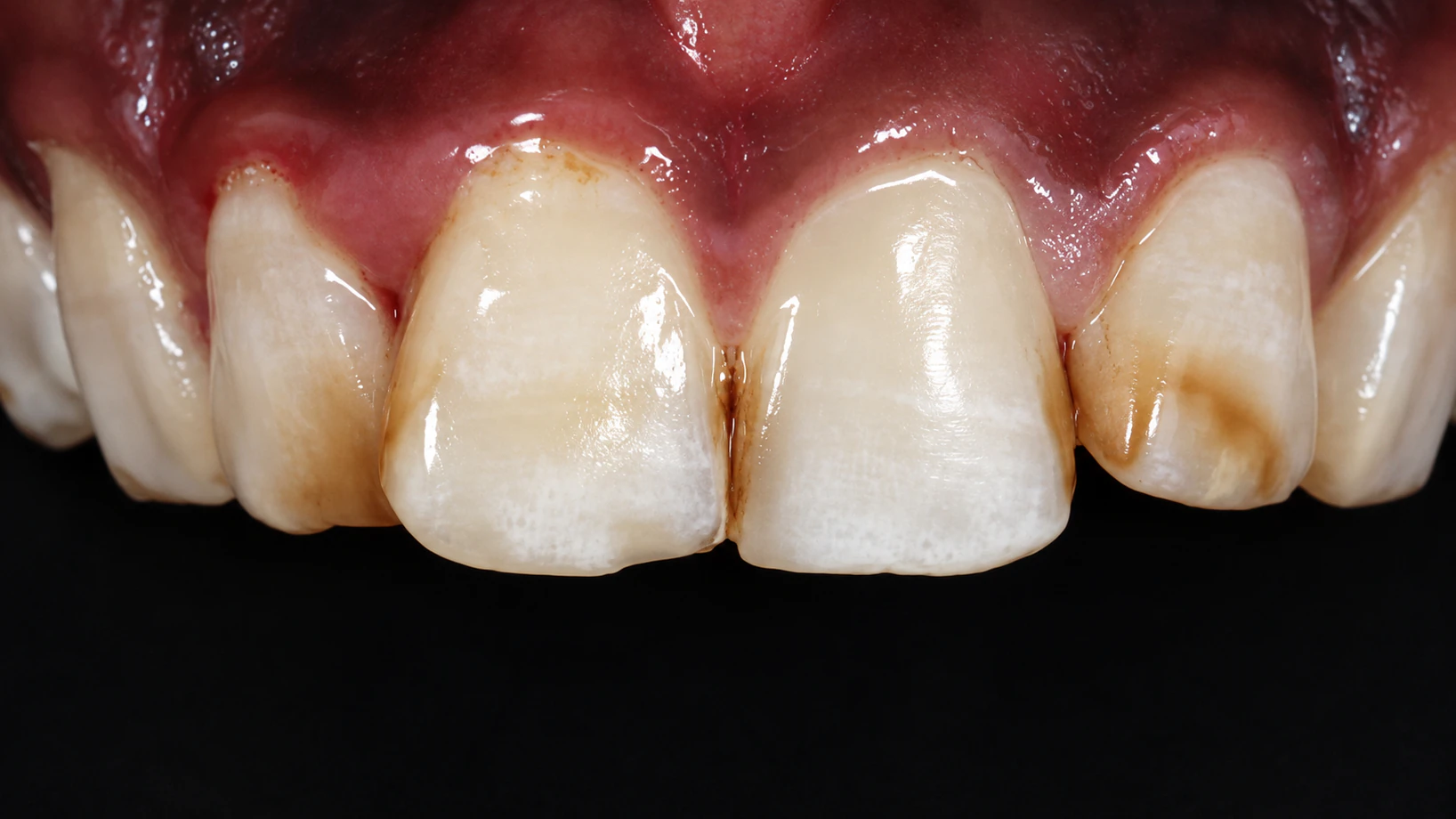 Smile before restorative dental treatment